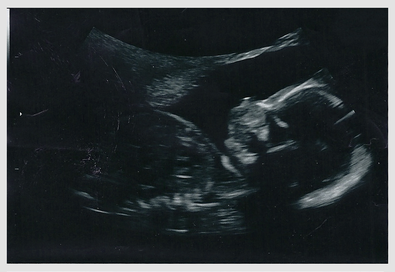I Am Your Father - Part 3: The Second Scan